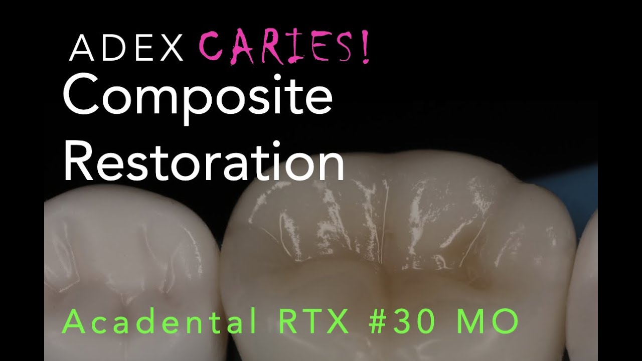 Composite Restoration for ADEX/CDCA Examination #30 MO
