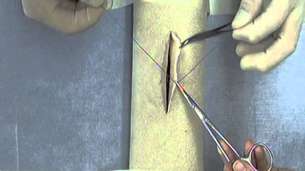 Ligation Around a Hemostatic Clamp