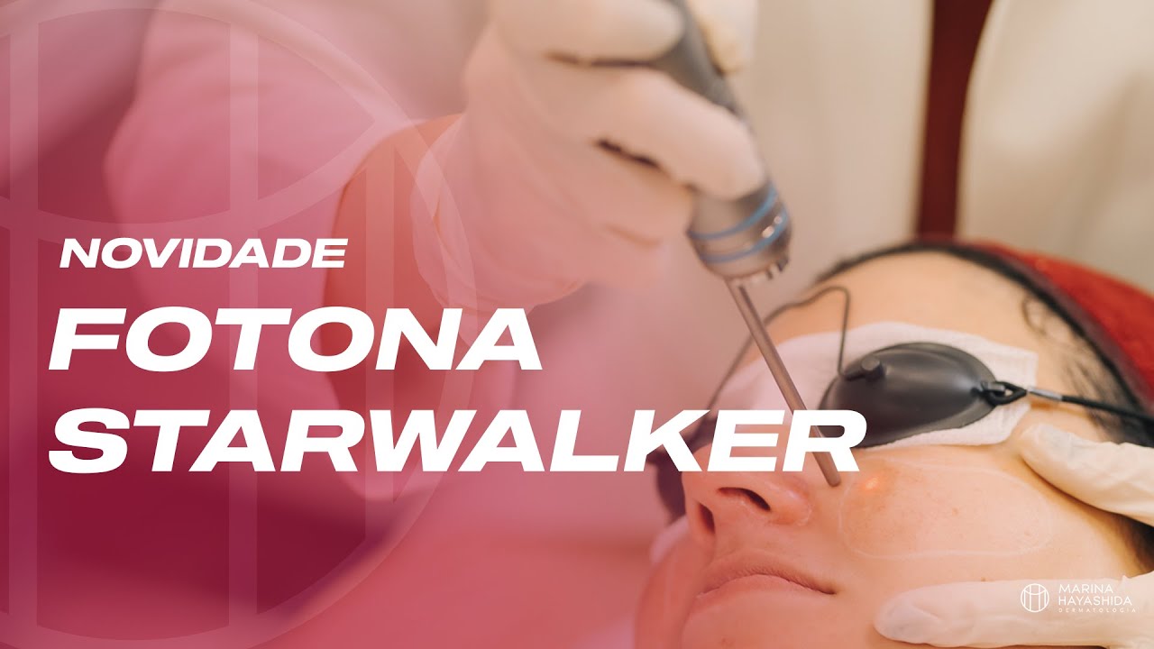Laser FOTONA STARWALKER | O laser Fotona que trata manchas na pele
