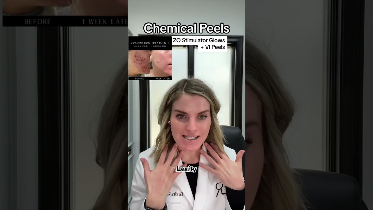 Chemical Peels options (ZO Stimulator Glows vs VI Chemical Peels)