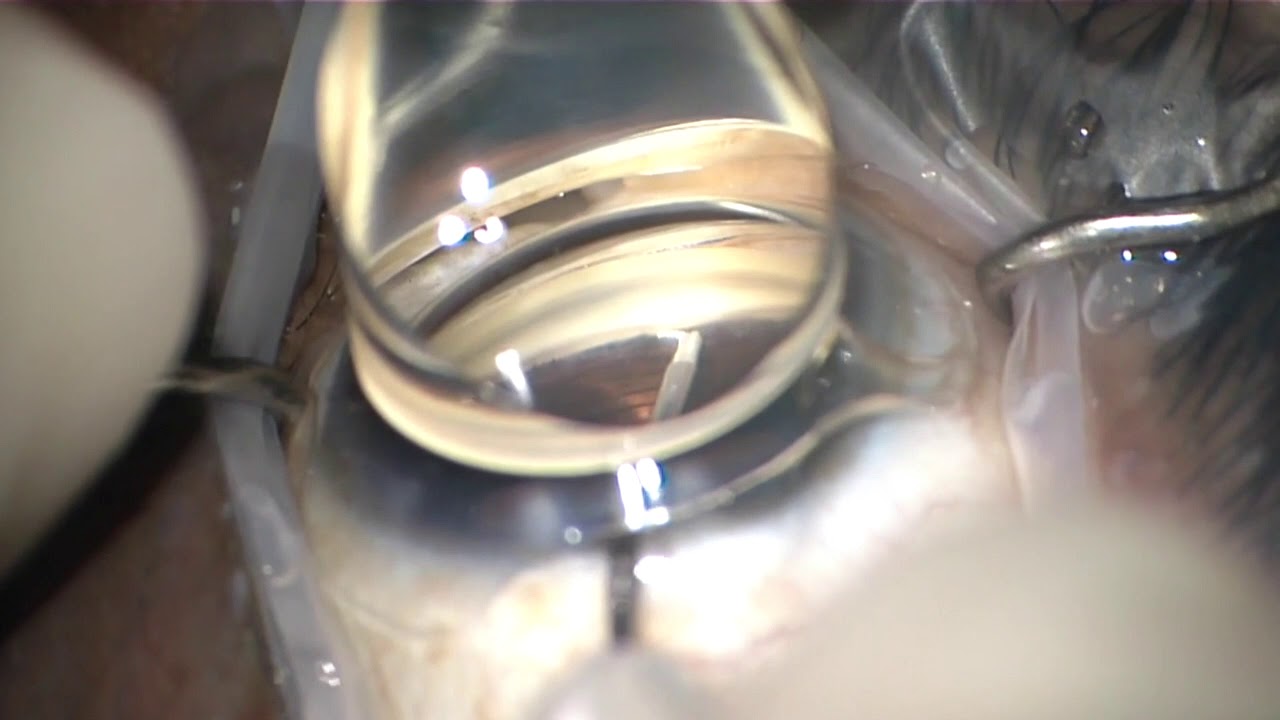 iStent (1st Generation) Insertion