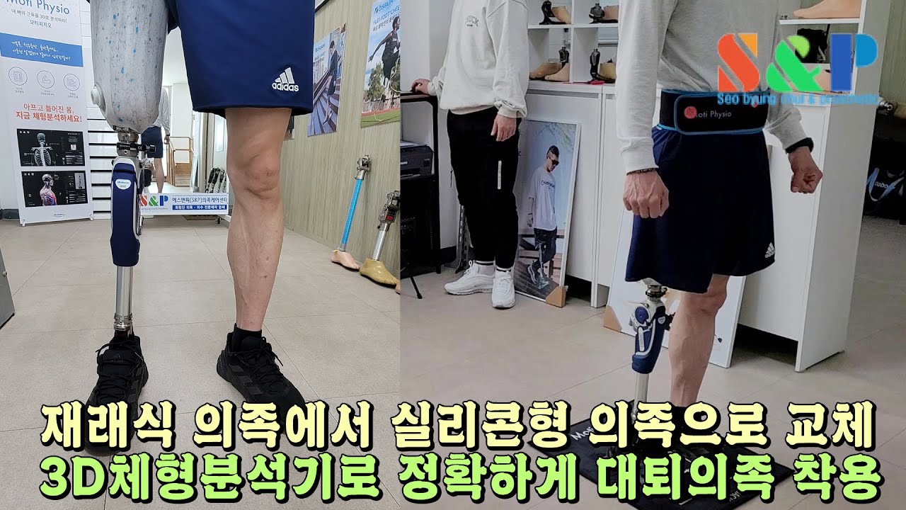 재래식 의족에서 실리콘형 의족으로 교체 : 3D체형분석으로 정확한 의족착용