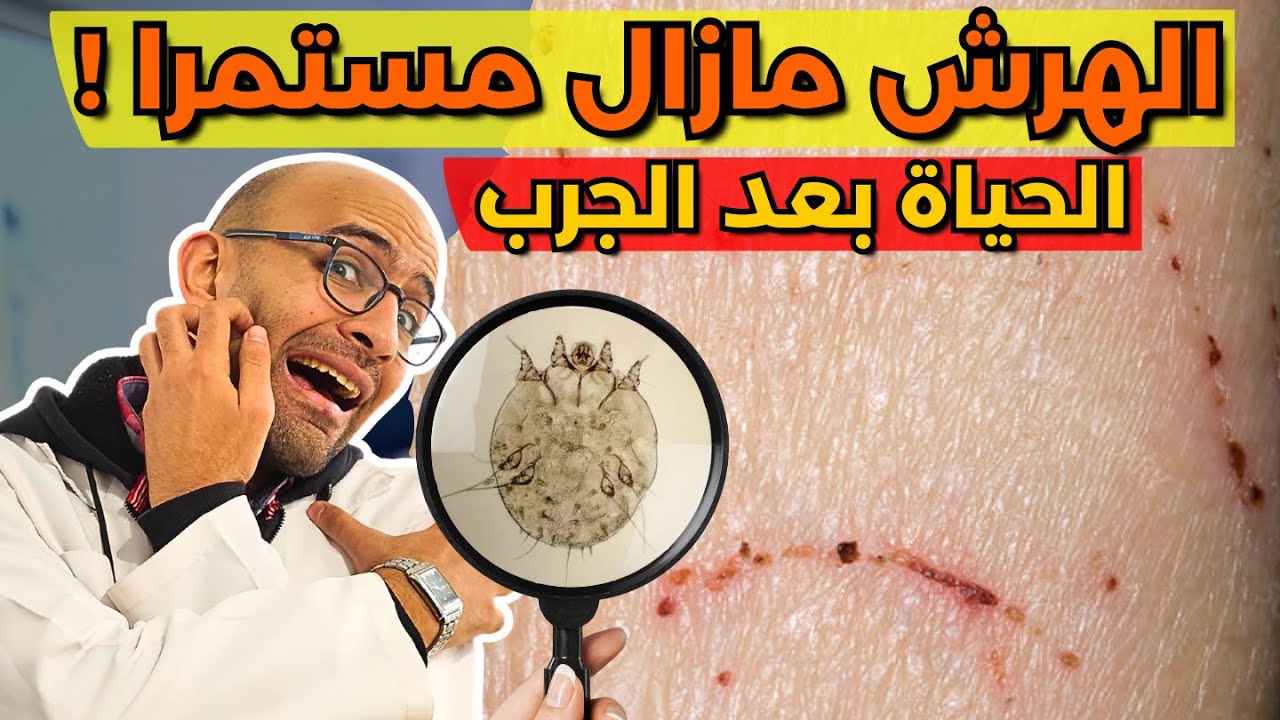 متلازمة ما بعد الجرب - ليه الهرش مستمر؟! وهل الجرب رجعلك تاني ؟!