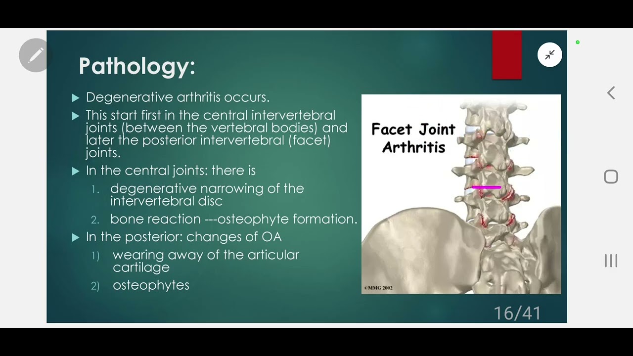 Spondylosis- Rheumatic diseases 