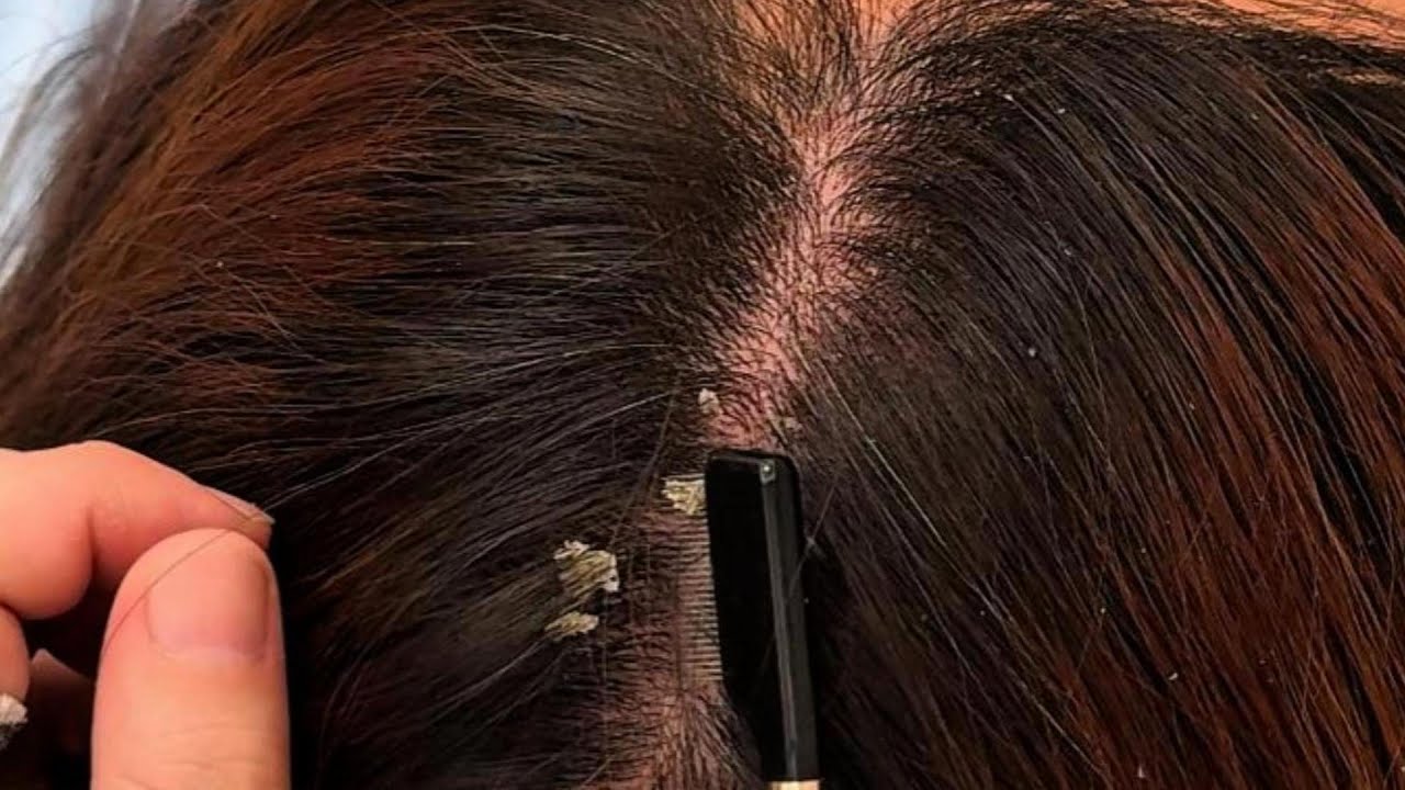 Relaxing Scalp ASMR with Jojo ｜ Tweezers & Fine Comb Sounds