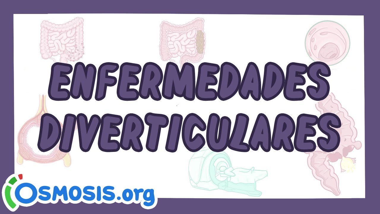 Diverticulosis y diverticulitis  - Ósmosis en Español