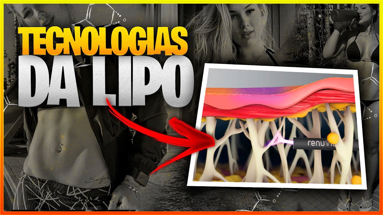 TECNOLOGIAS DA LIPO | Renuvion, Vaser ou Microaire | Dr Daniel Botelho Cirurgia Plástica