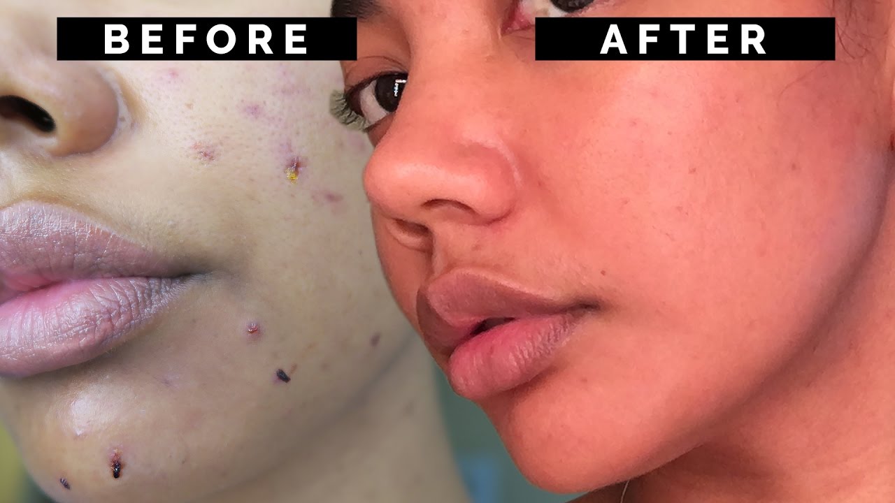 HOW TO FINALLY GET RID OF ACNE!! • How I Cleared My Skin Pt. 1
