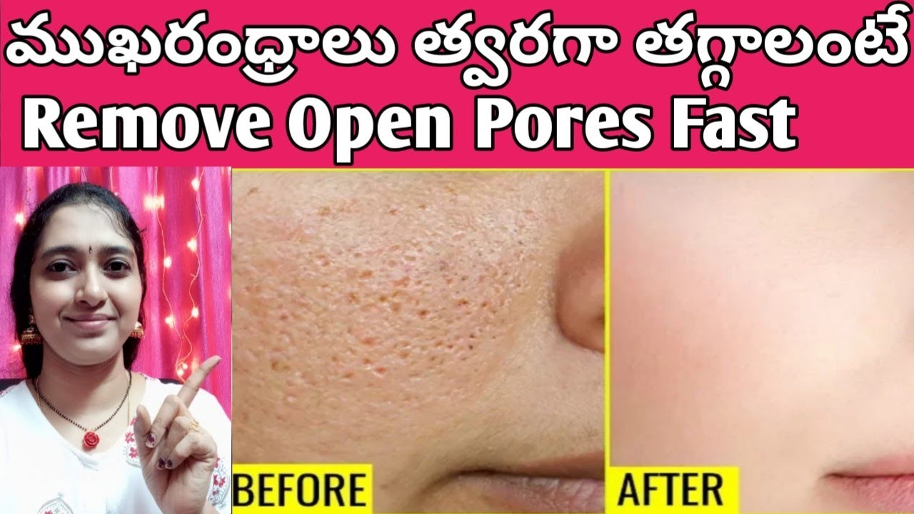 How To Remove Open Pores Naturally In Telugu/Open Pores Home Remedy In Telugu/Face Holes Treatment
