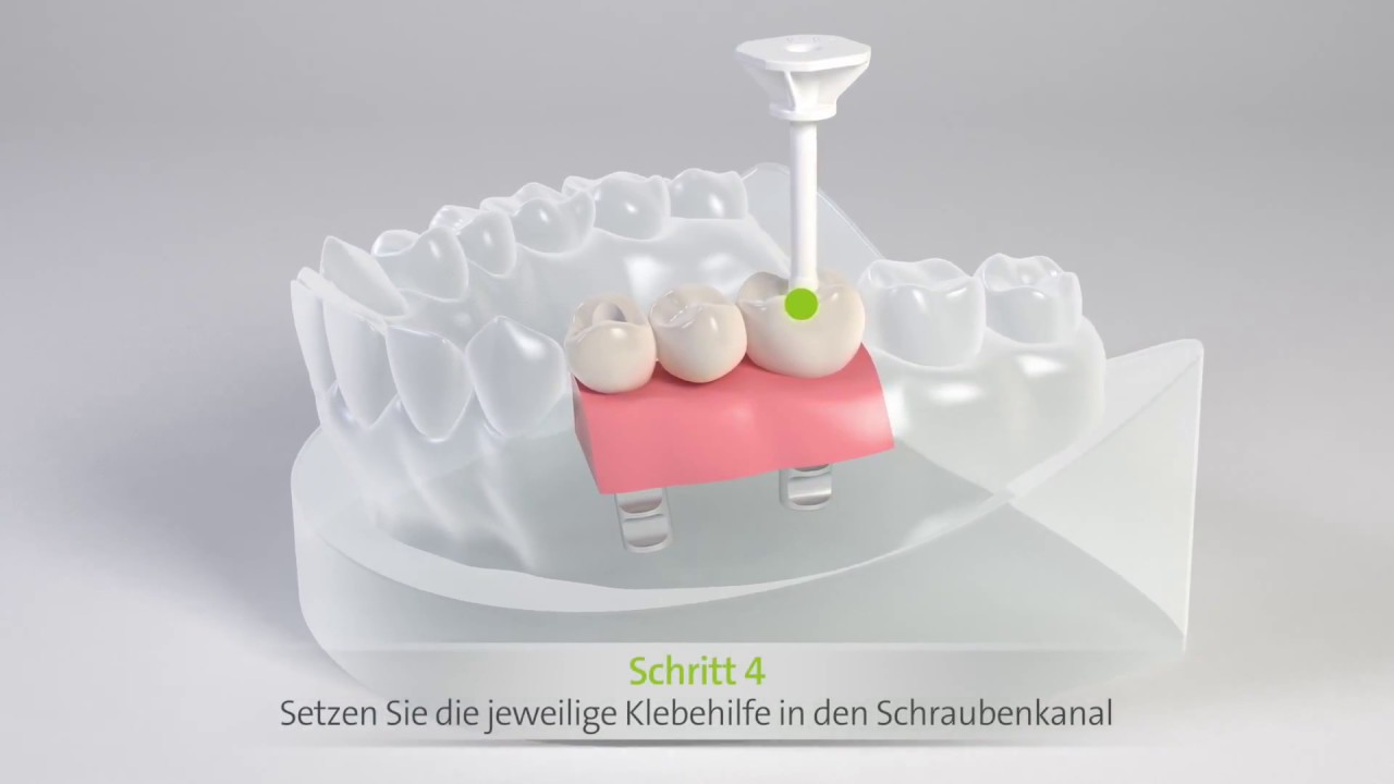 Straumann&reg; Variobase&reg; Klebehilfe