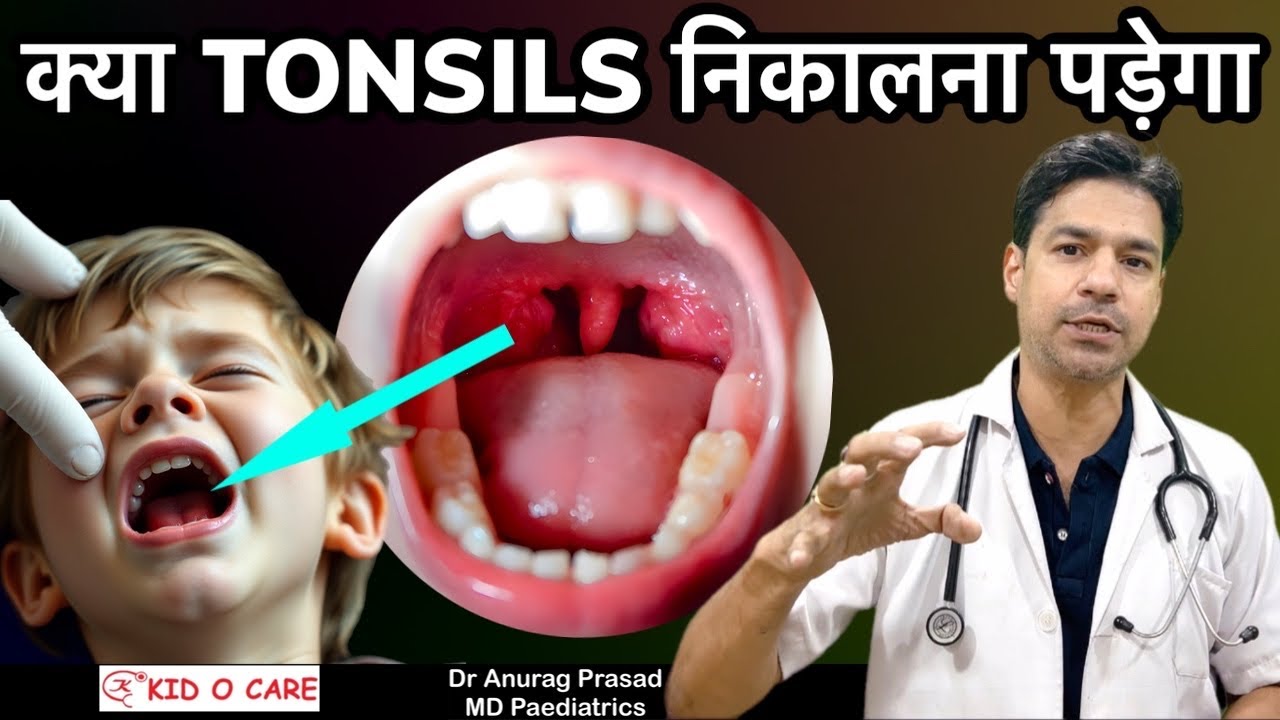 क्या Tonsils निकलवाना सही है? जानिए Tonsillectomy के सही Indications By Dr Anurag Prasad