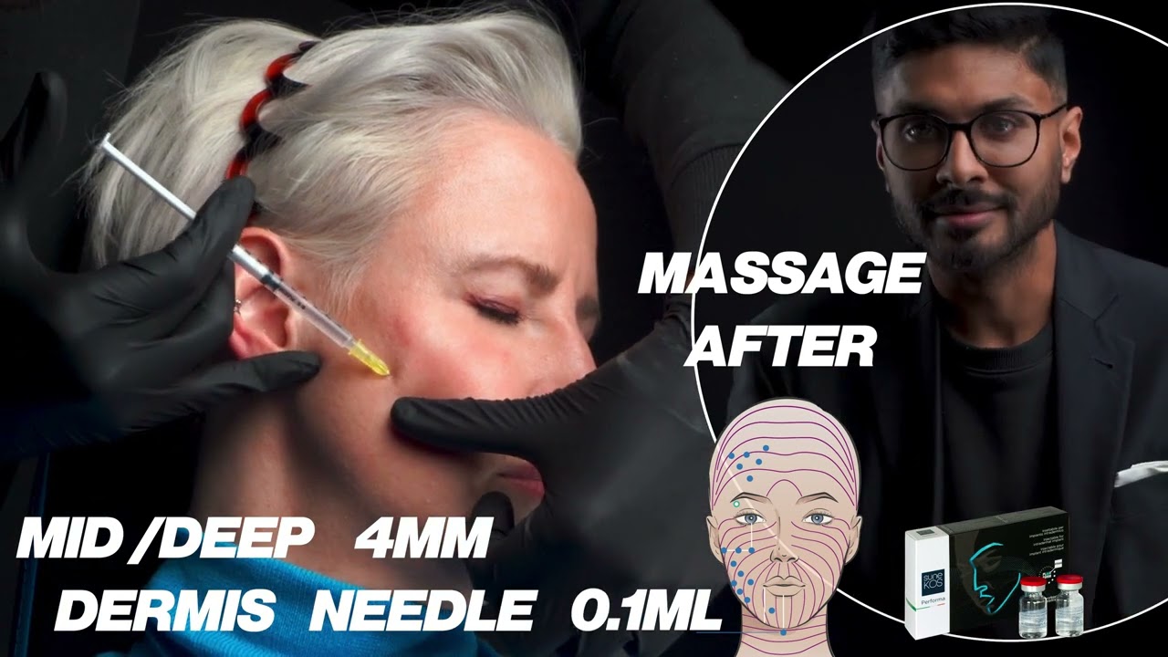 Dr. Abs - Sunekos Performa Injection Technique Face