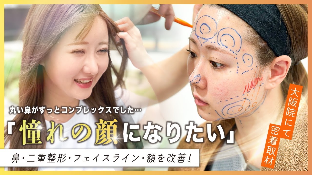 【初めての鼻整形に挑戦します】丸い鼻がコンプレックスの女性の鼻含めた全顔整形に密着取材【徹底密着】実際のダウンタイムの映像も大公開します【美容整形】 #zetithbeautyclinic #大阪