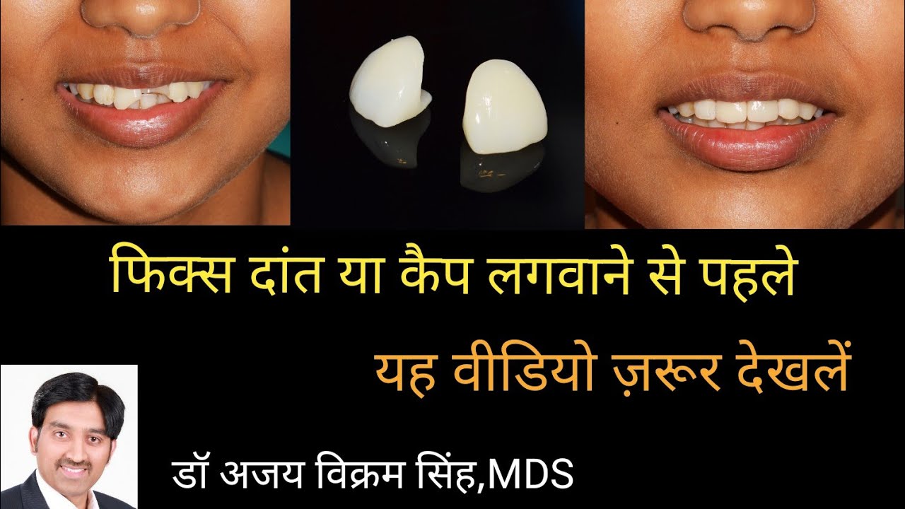 सावधान! दांतों अथवा इंप्लांट पर कैप लगवाने से पहले ये वीडियो अवश्य देखें