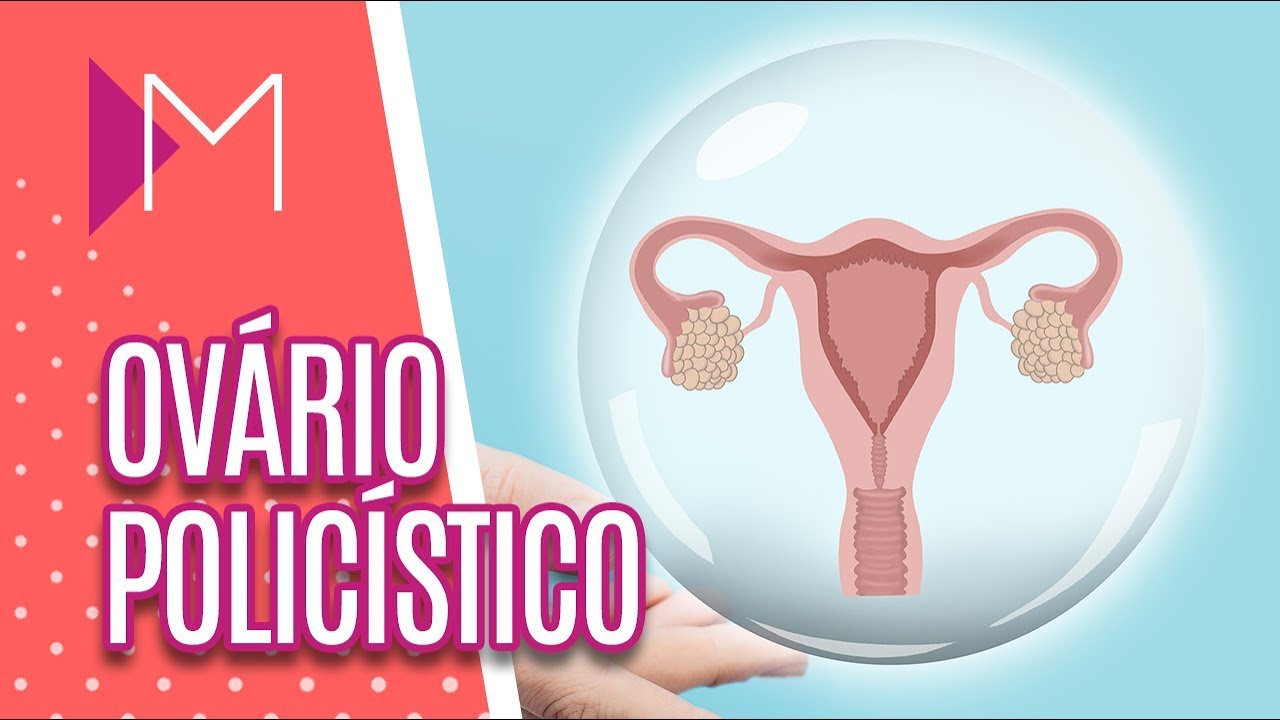 Síndrome do ovário policístico: causas e tratamentos - Mulheres (09/01/2020)