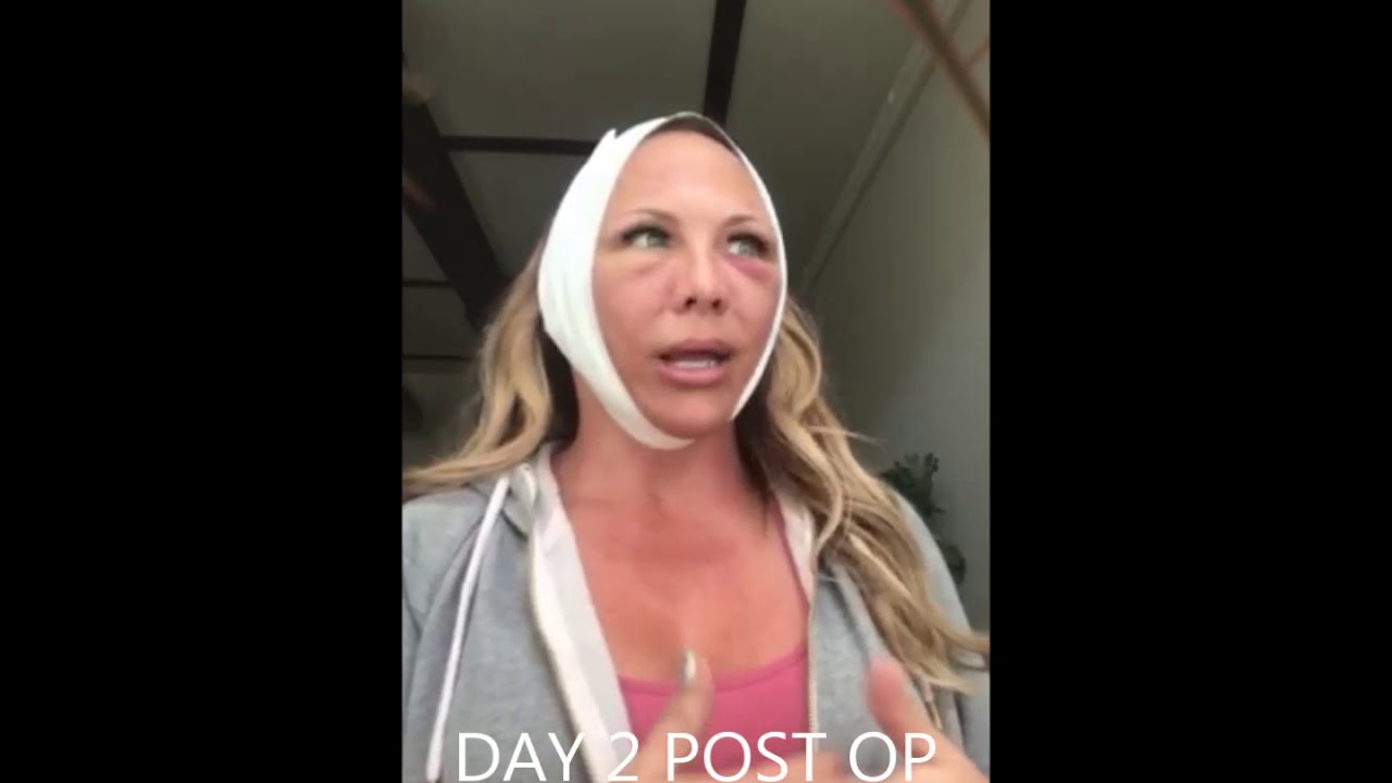 Day By Day Weekend (Mini) Facelift Recovery