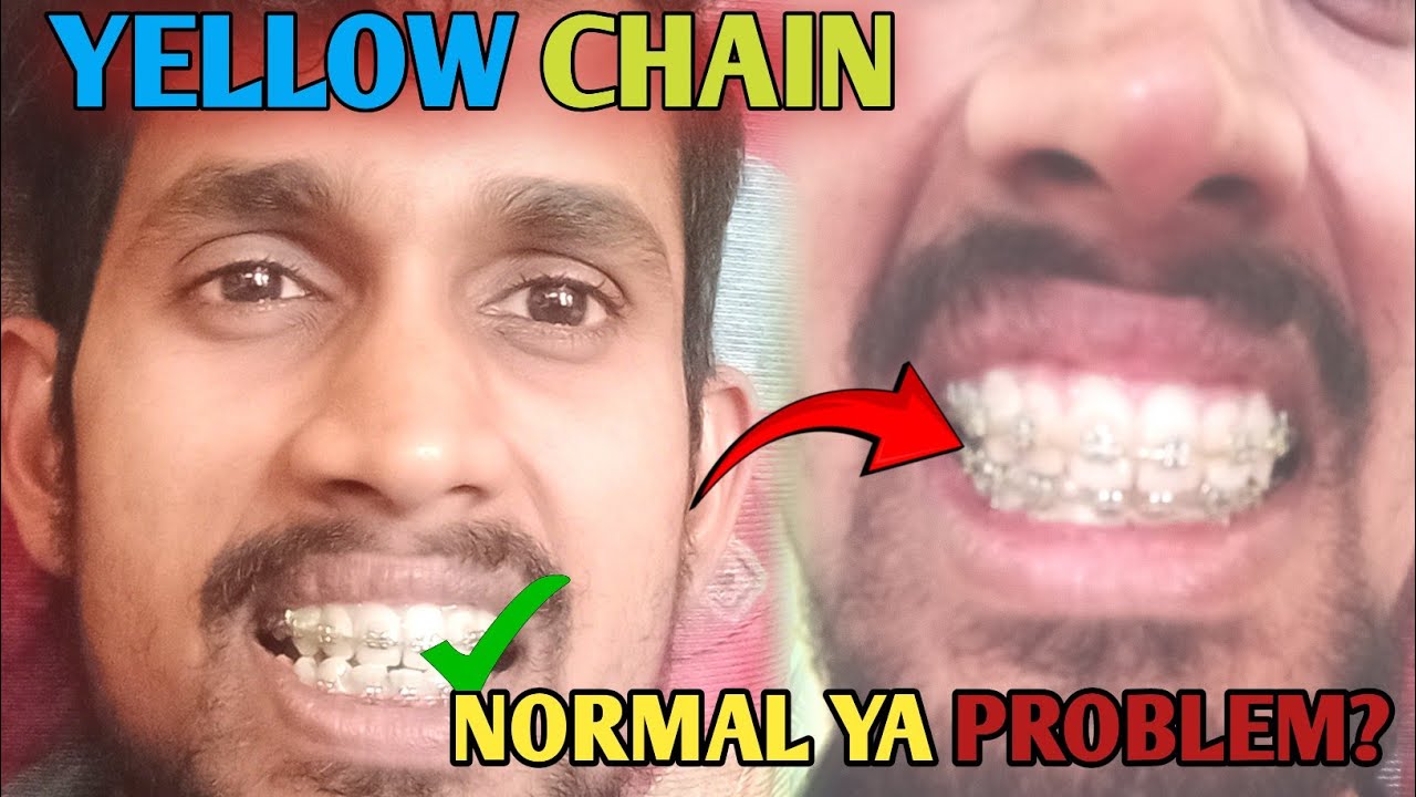 Braces Me Yellow Chain 😱 | Ye Infection Hai Ya Treatment Ka Part?