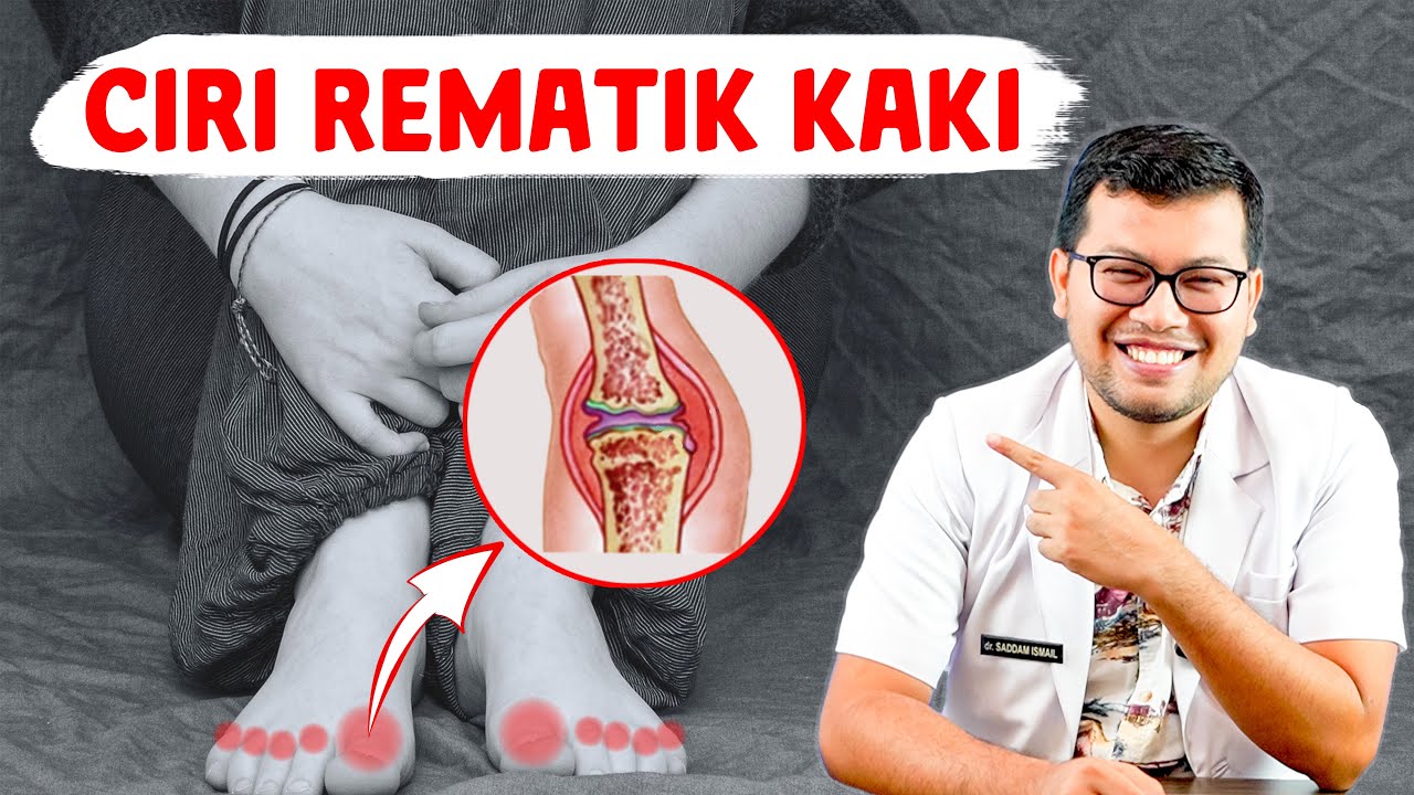GEJALA KAKI TERKENA SAKIT REMATIK - DOKTER SADDAM ISMAIL