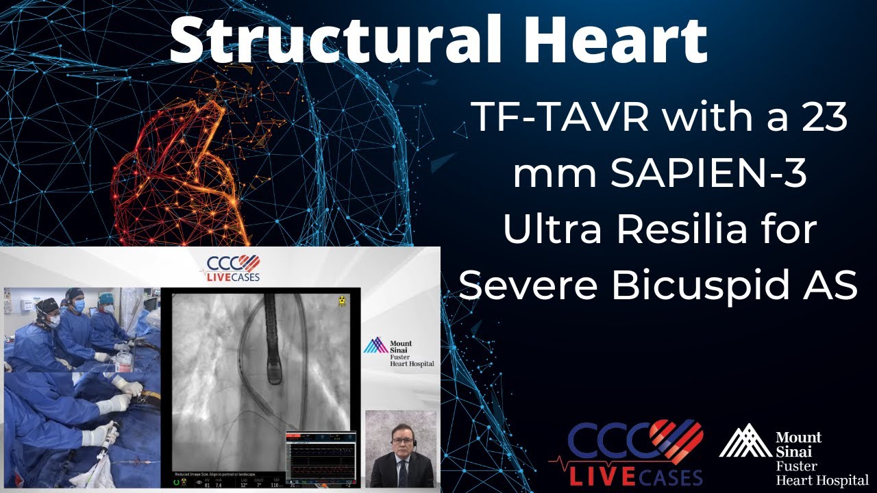 TF-TAVR with a 23 mm SAPIEN-3 Ultra Resilia for﻿Severe Bicuspid AS