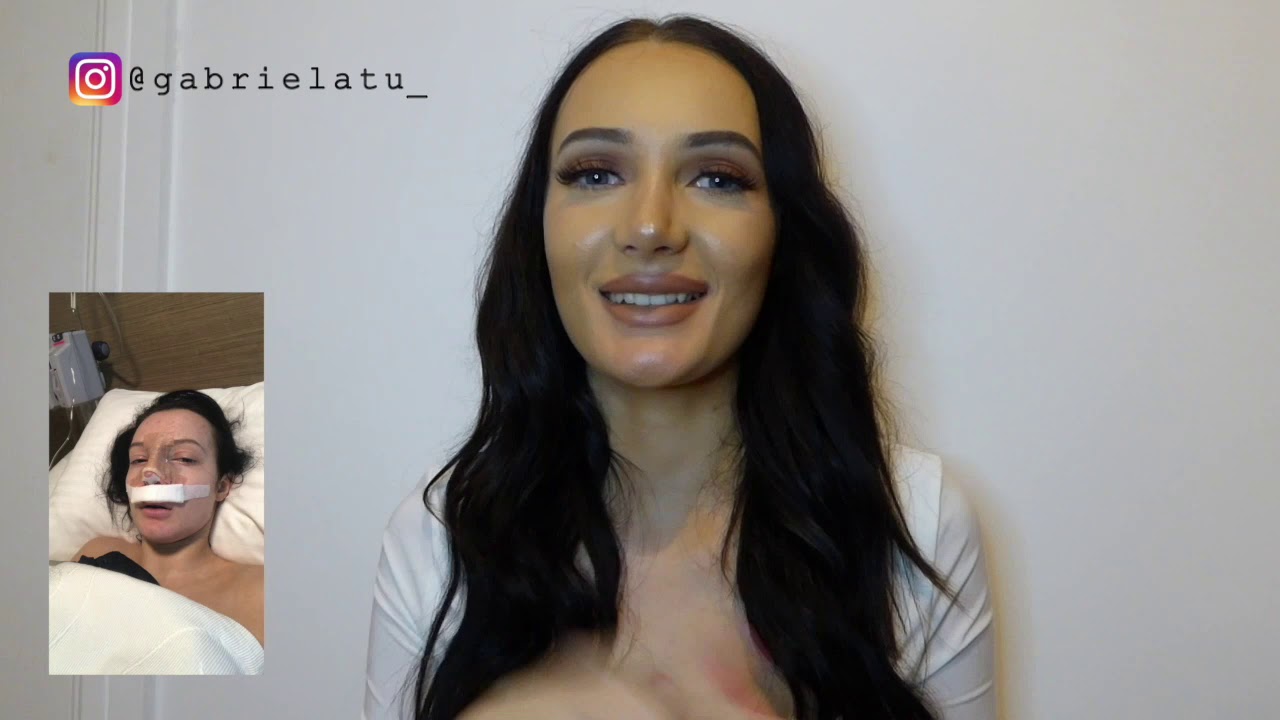 My rhinoplasty experience in Turkey (Nose job)