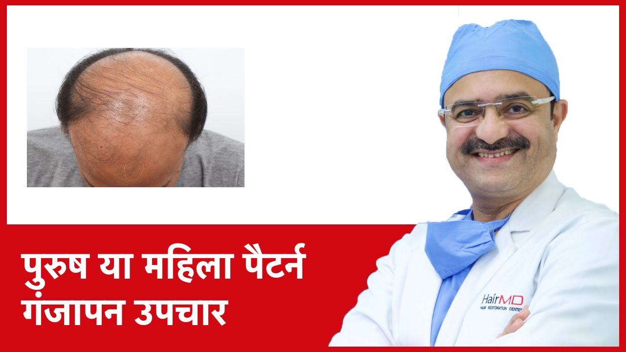 Male or Female Pattern Baldness Treatments (पुरुष या महिला पैटर्न गंजापन उपचार) | (In HINDI)