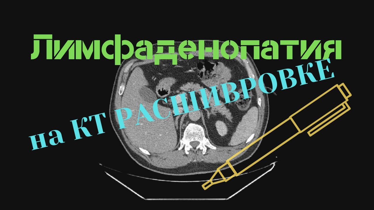 Лимфаденопатия средостения и брюшной полости на КТ расшифровке снимков с диска. Кисты обеих почек.