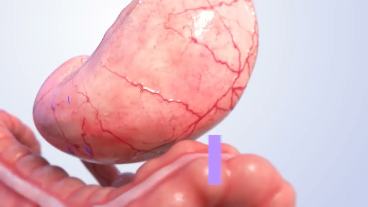 ESG - ABNEHMEN OHNE OP - Endoskopische Sleeve Gastroplastik - Salzburg