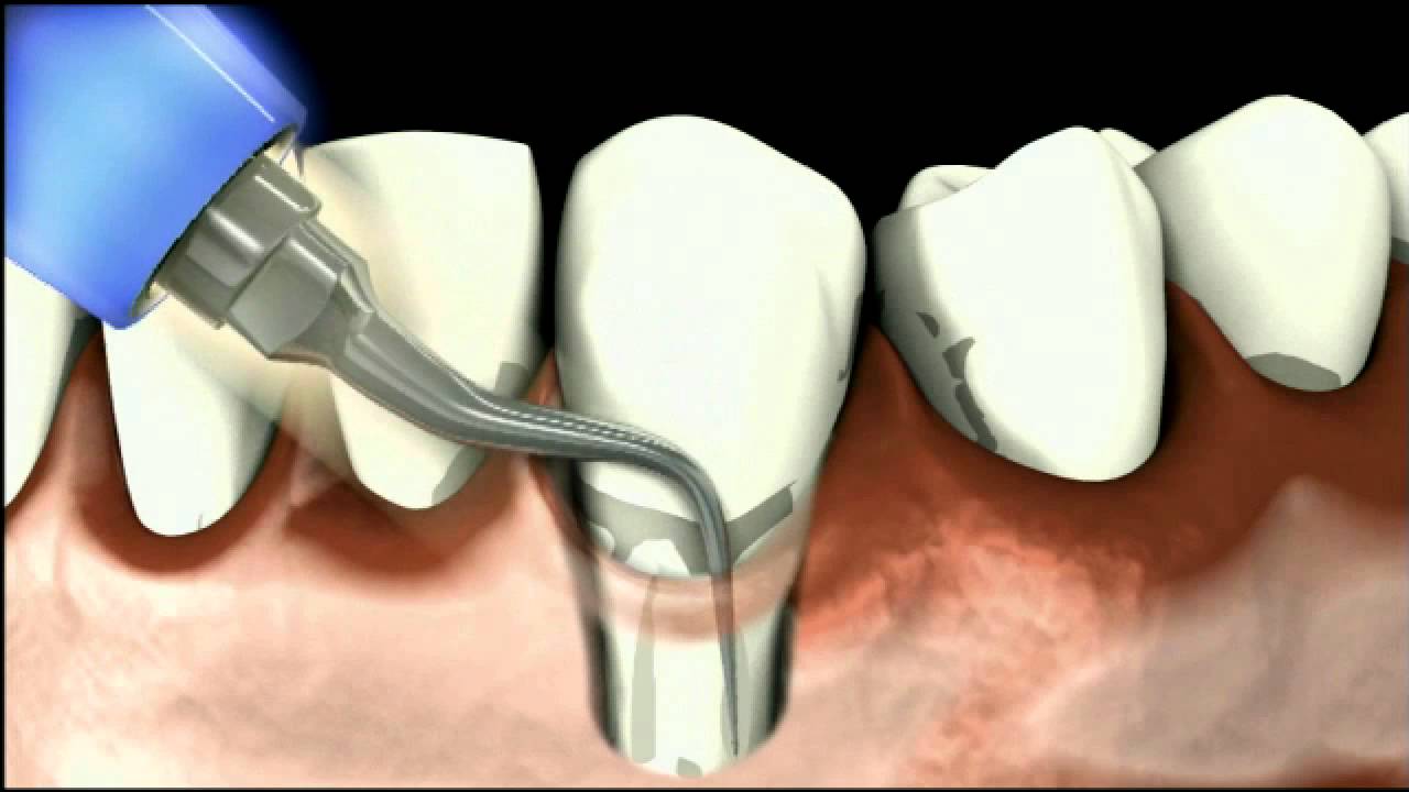 Sirona Perioscan Produktfilm