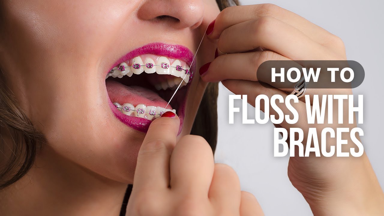 How to Floss with Braces