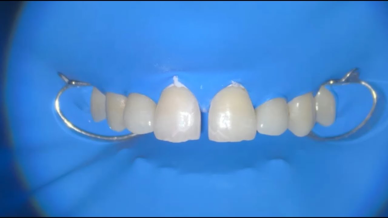 DİASTEMA CLOSURE, DİASTEMA KAPATMA, ESTETİK DOLGU