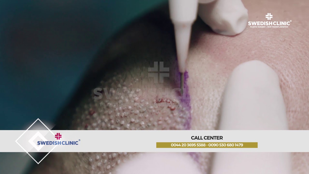Dhi - Choi  Hair transplantation