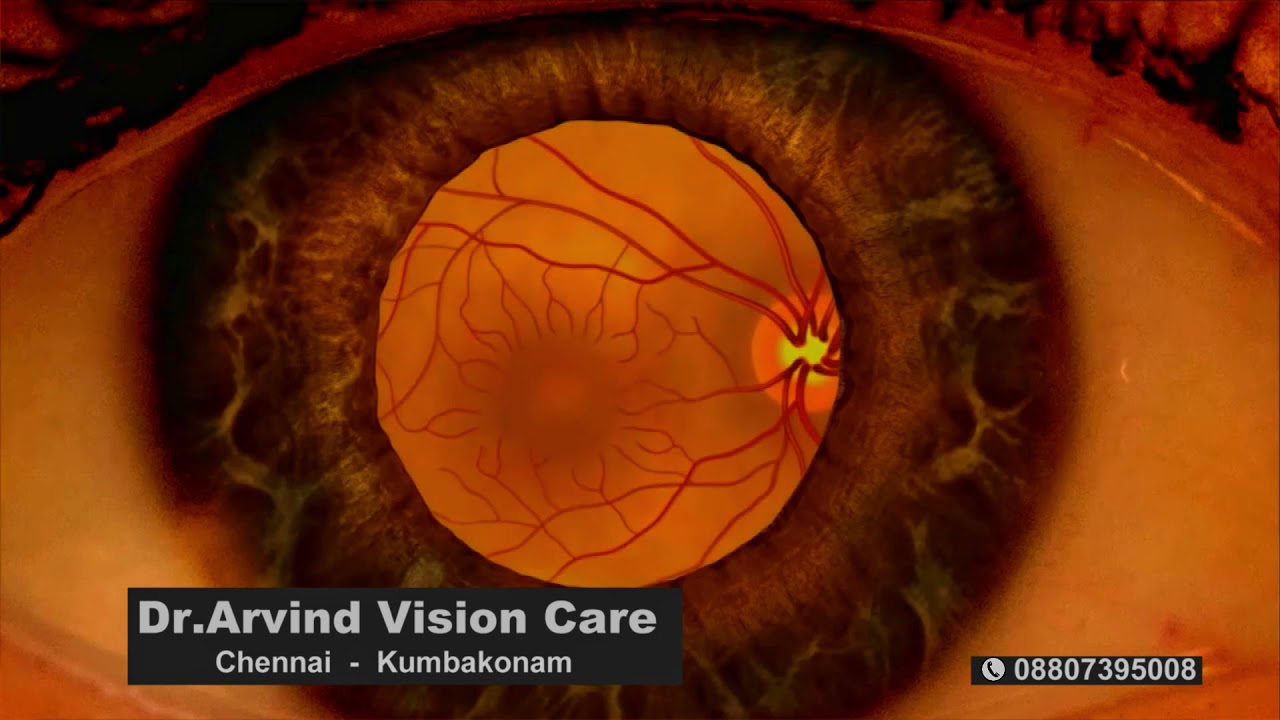 Diabetes related eye problem