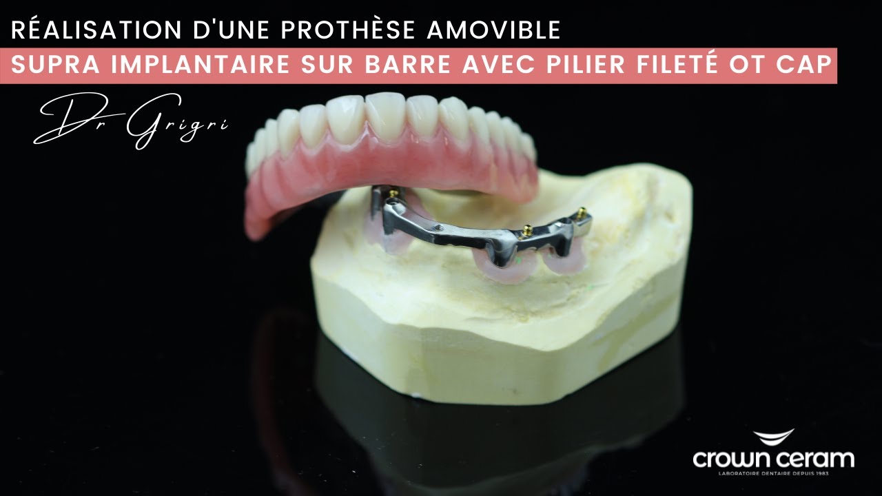 Réalisation d'une prothèse amovible supra implantaire sur barre avec pilier fileté OT CAP