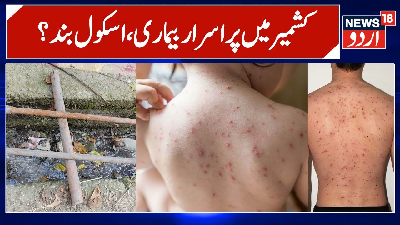 Chickenpox Outbreak Among Children | School in Kashmir Closed?, Contaminated Drinking Water | News18