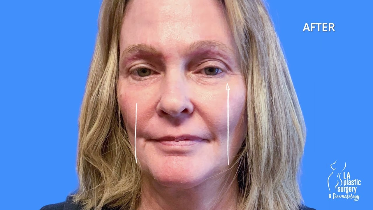 TRIFECTA FACELIFT - Facelift/Fat Grafting/Skin Resurfacing