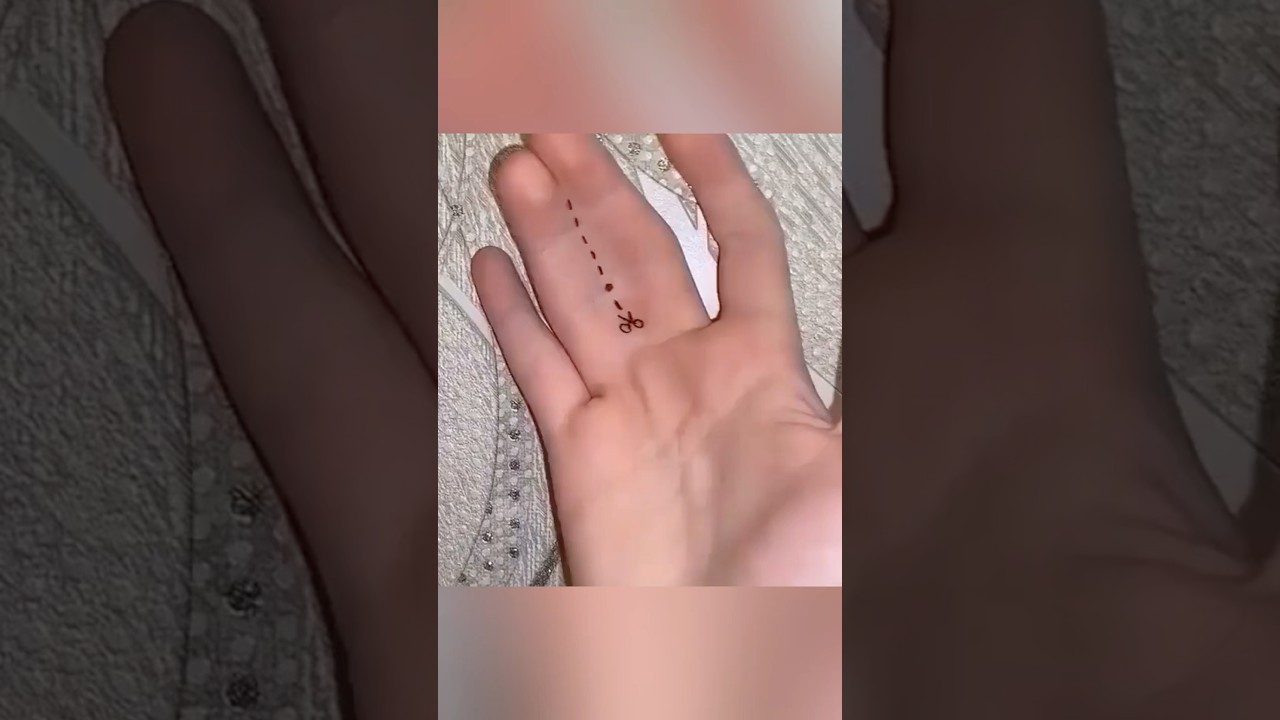 Why Are His Fingers Fused Together?