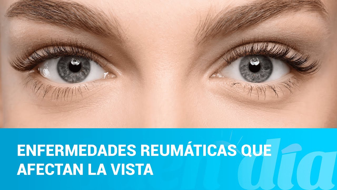 Enfermedades reumáticas que afectan la vista