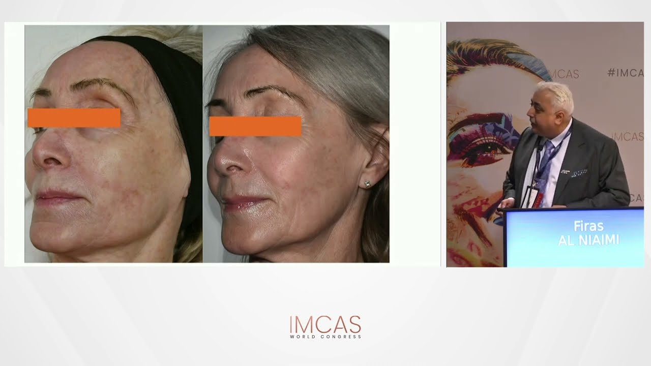 Microneedling with Exosomes: The Future of Skin Regeneration - Prof. Firas Al Niaimi - Imcas 2025