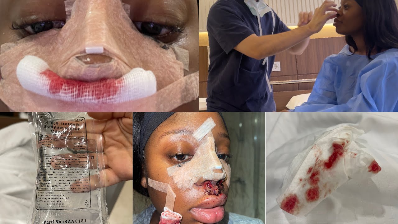 I GOT A ETHNIC RHINOPLASTY IN TURKEY  (THE GOOD, THE BAD, AND THE UGLY)