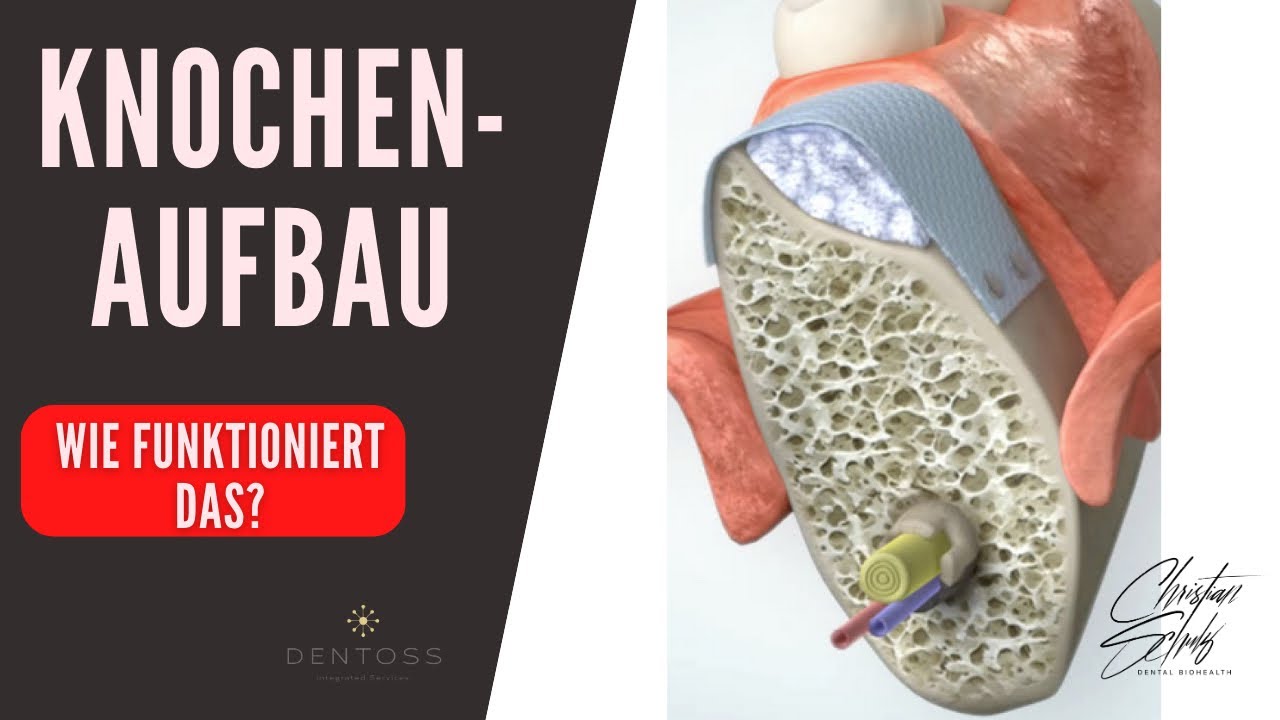 Knochenaufbau für ein Zahnimplantat. Wie funktioniert das?