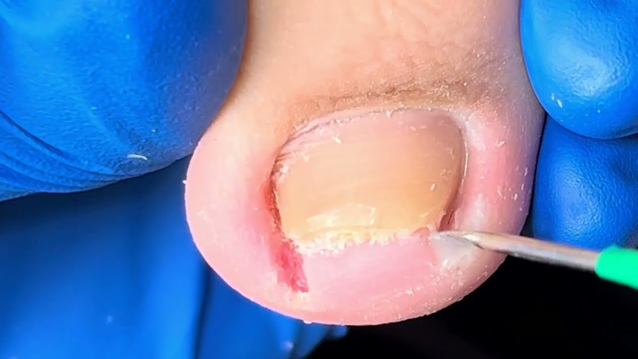 Amazing curly toenail trimming process! Good effect【Xue Yidao】