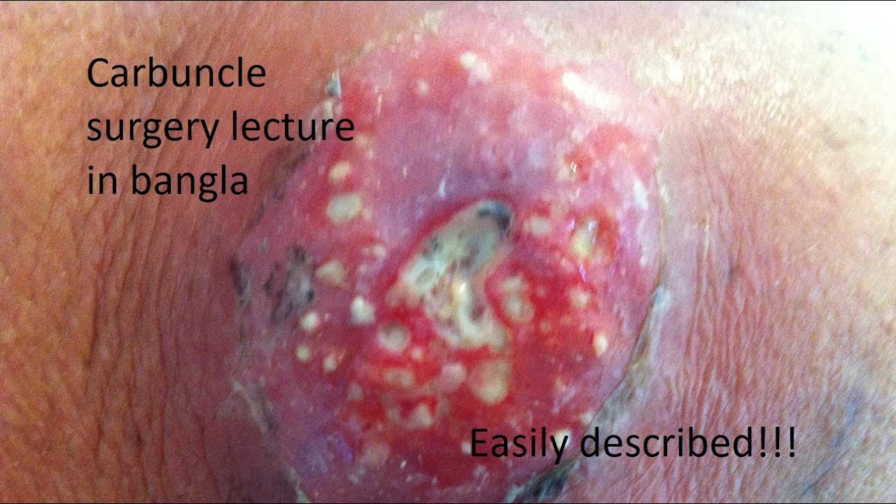 Surgery lecture Carbuncle | Bangla | Short discussion
