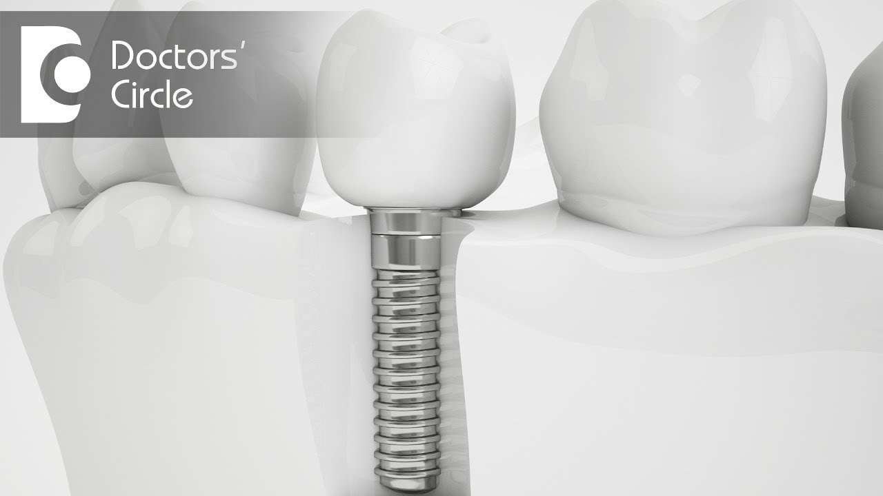 What are the side effects associated with Dental Implants? - Dr. Sudhakara Reddy