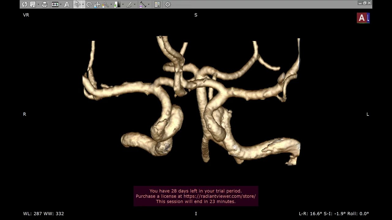 🧠 Así se ve el Polígono de Willis en 3D: la Irrigación Arterial del Cerebro como Nunca Antes.