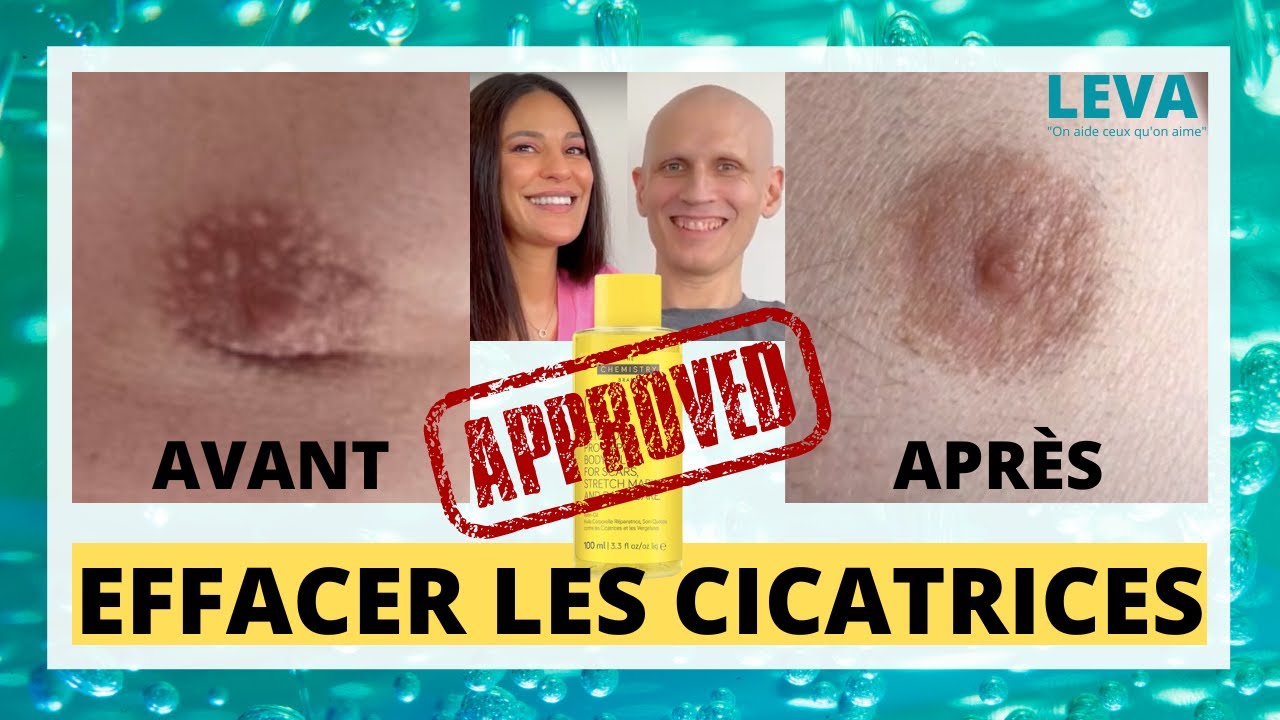 RETIN OIL THE CHEMISTRY BRAND, POUR EFFACER LES CICATRICES, AVANT APR&Egrave;S
