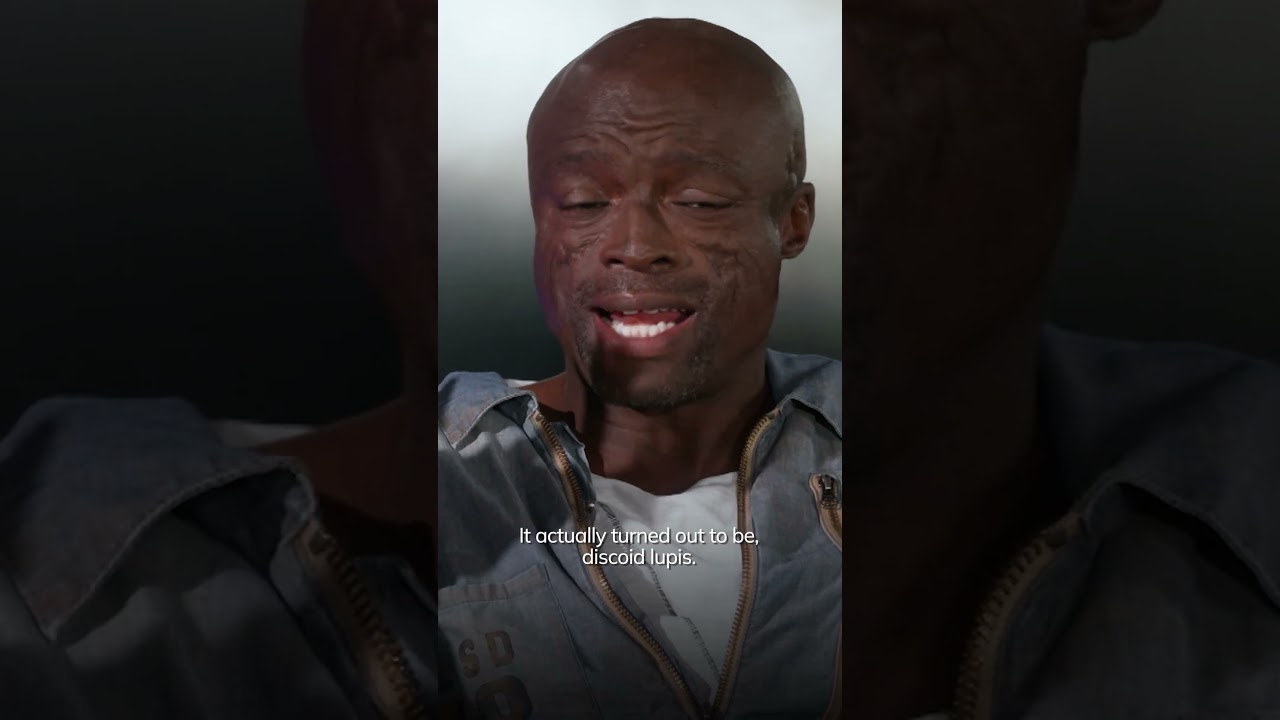 Seal discusses the origin of his facial scars &mdash; or his 