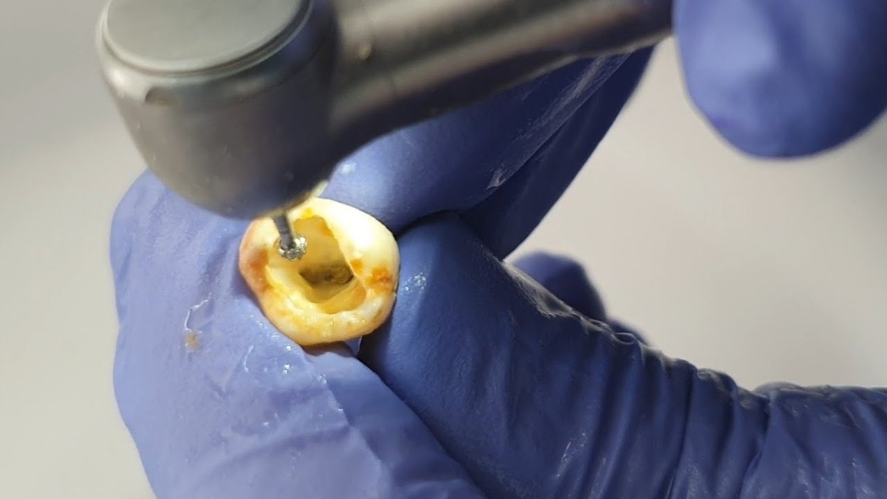 Kanal Tedavisinde Giriş Kavitesi Açarken Dikkat Edilecekler