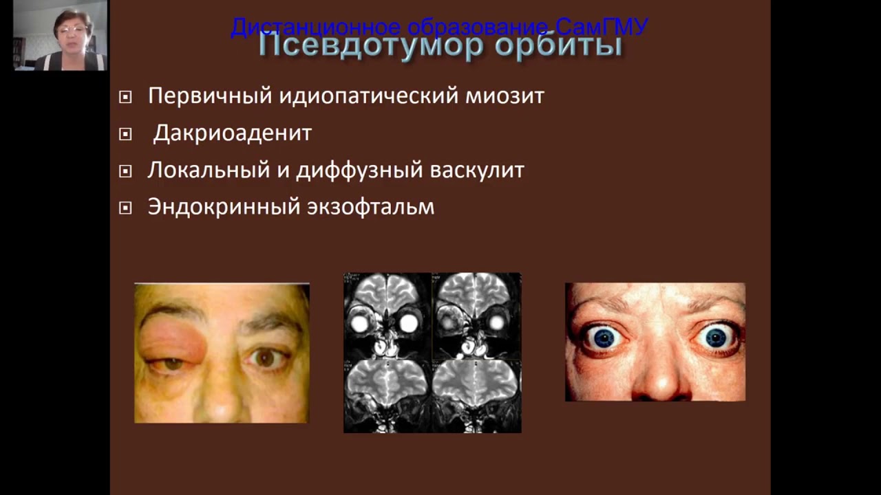 Патология орбиты, косоглазие