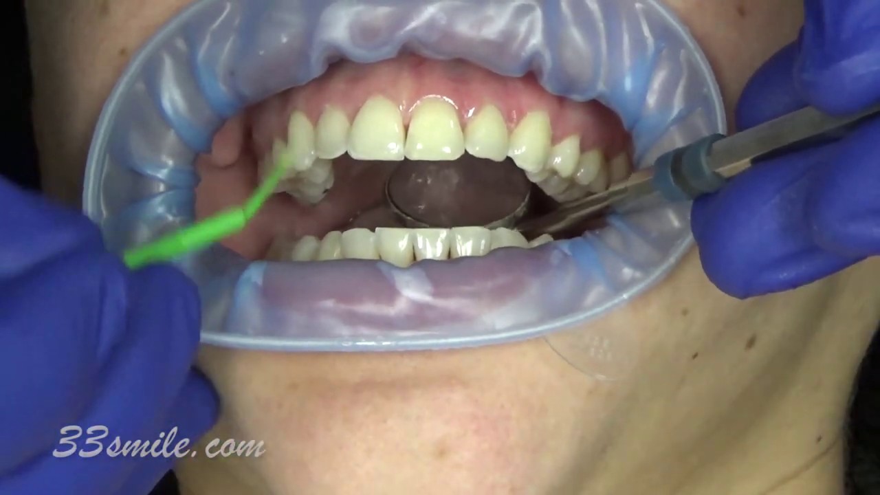 cosmetic dentistry before and after prepless porcelain dental veneers