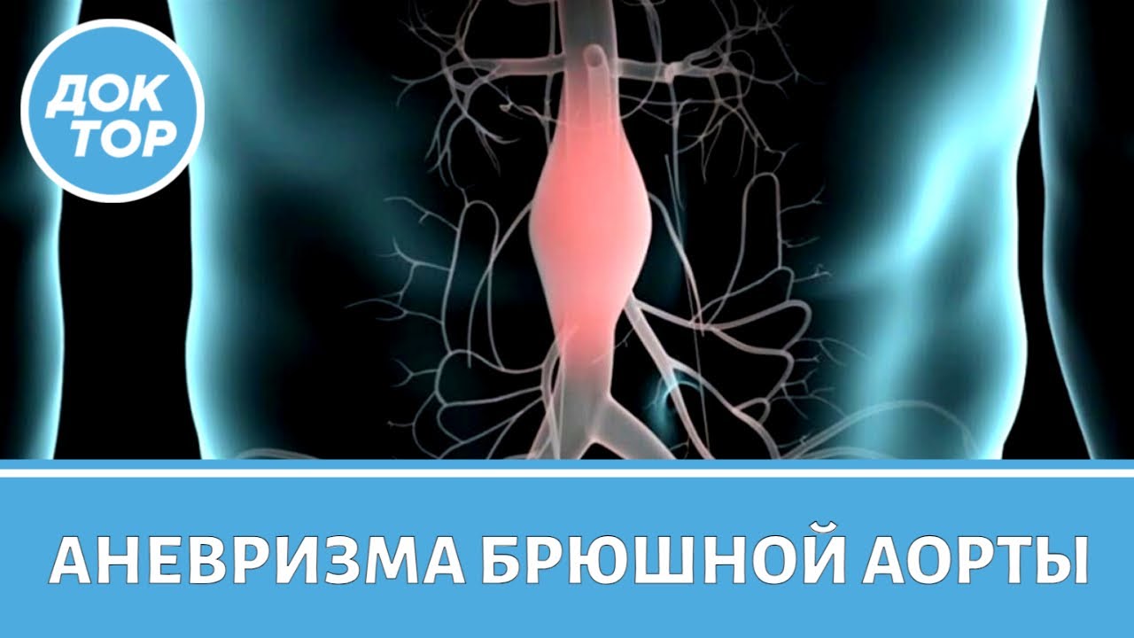 Как не пропустить у себя аневризму брюшной аорты